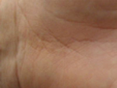 Eine Handinnenseite mit minimal sichtbarer Narbe ist zu sehen.