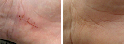 Ein Vorher- und Nachher-Vergleich einer Narbe auf einer Handinnenseite.