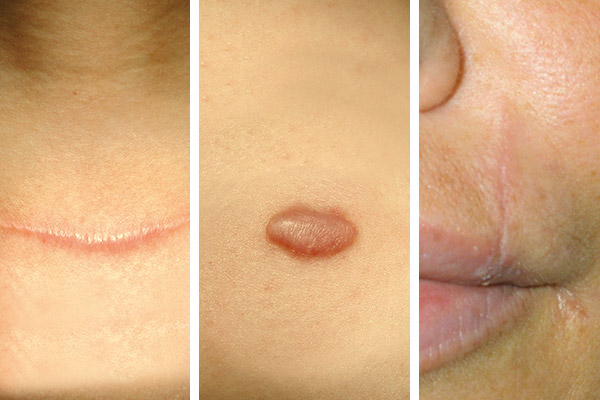 Abbildung von drei verschiedenen Narbenformen: eingesunkene Narbe, erhabene Narbe und ein Narbenkeloid.