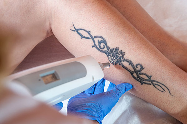 Ein Tattoo am Unterschenkel wird bei einer Laserbehandlung entfernt.