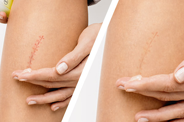 Ein Vorher- und Nachher-Vergleich einer Narbe am Bein mit der Behandlung von Contractubex.